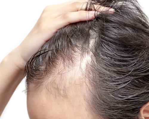 4 Ways to Stop or Combat a Receding Hairline